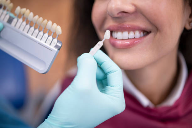 Porcelain Veneers