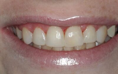 One Visit, A World of Confidence: A Dental Bonding Case Study