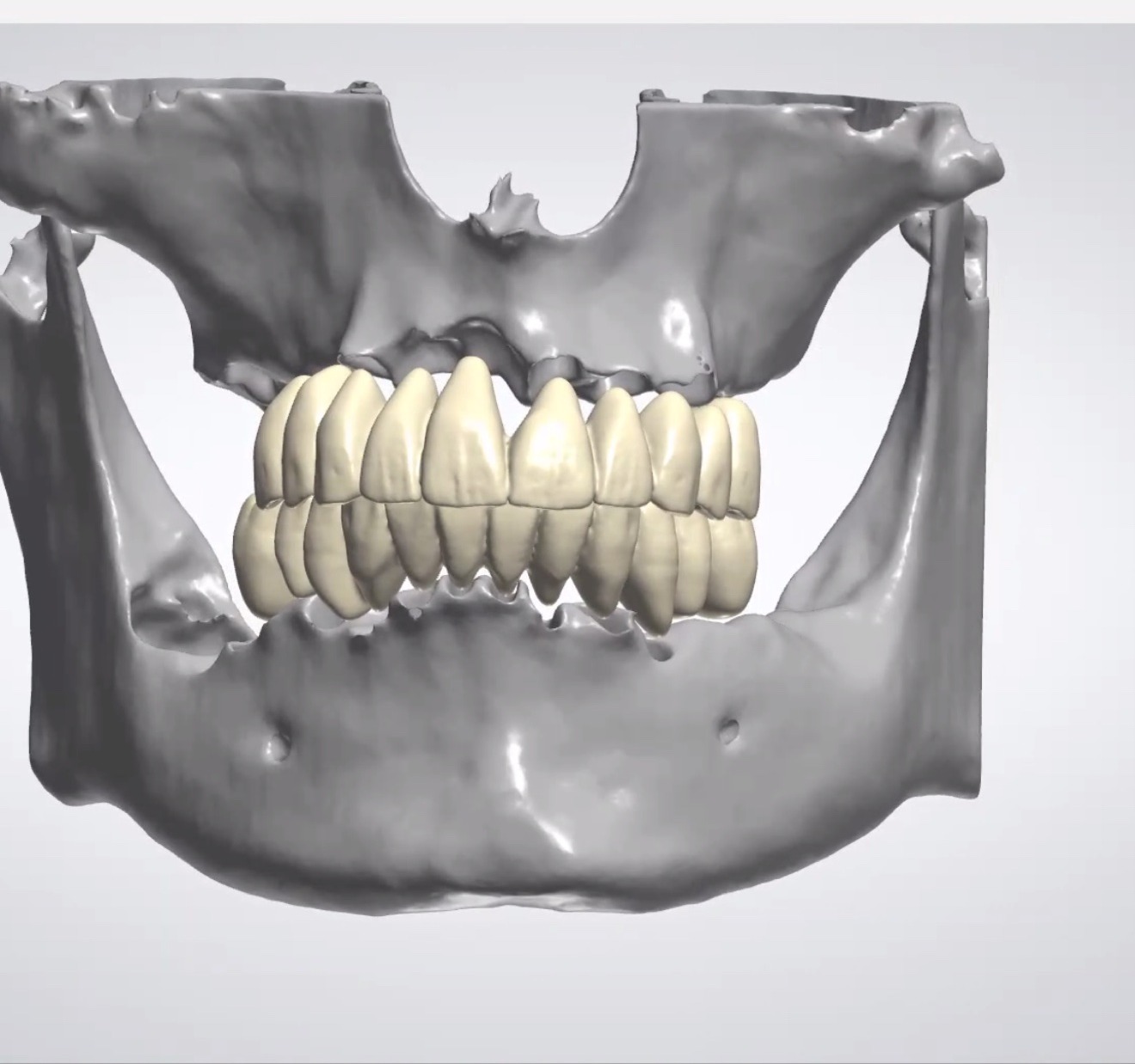 Digital 3D design of the final teeth before implant surgery