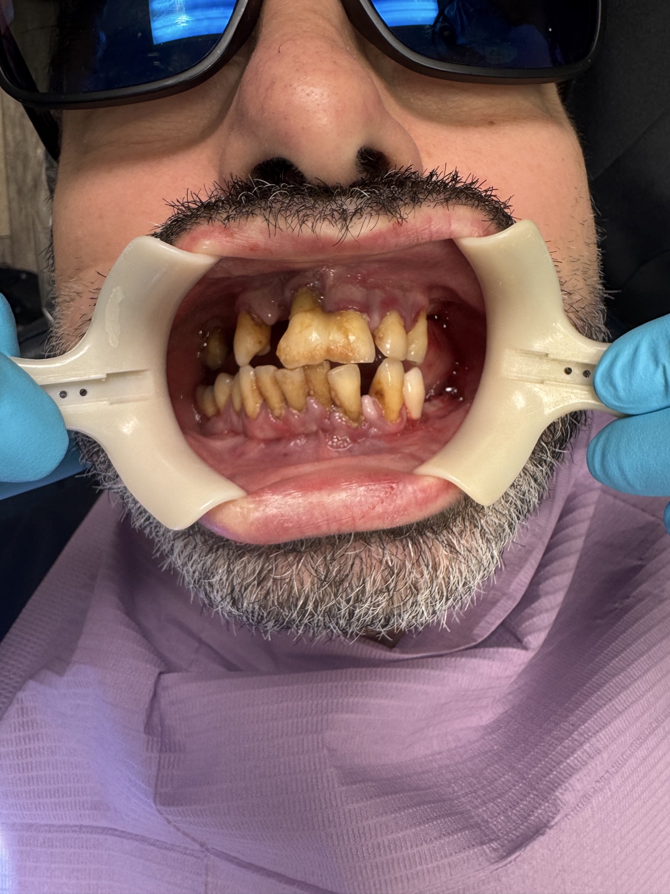 Failing teeth before full-mouth rehabilitation