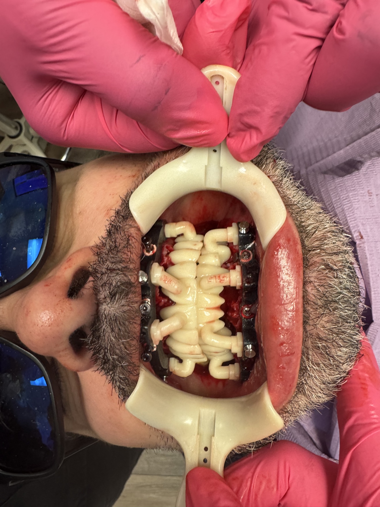 Custom surgical guide seated during implant surgery