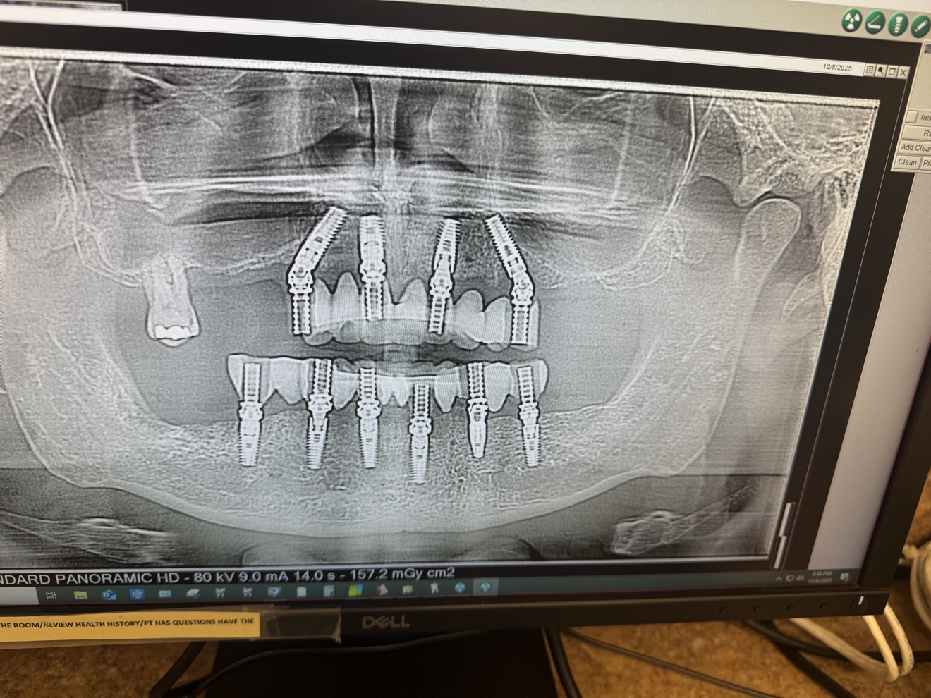 Panoramic X-ray after treatment: upper arch on four implants, lower arch on six