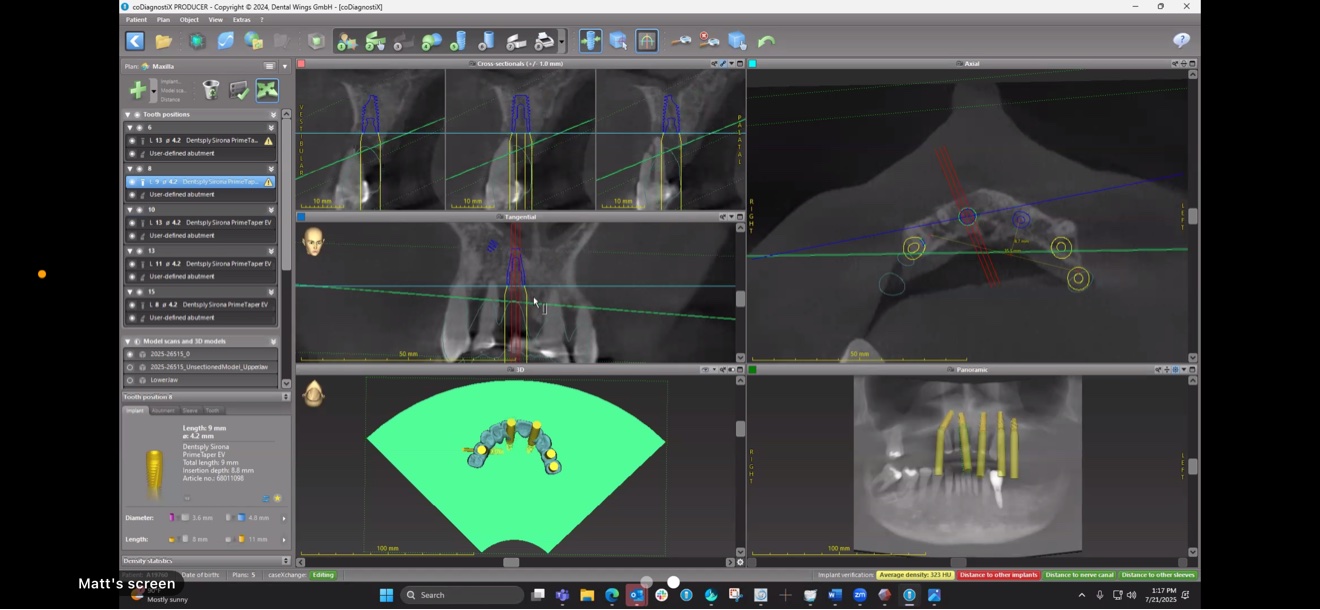 3D implant plan for both arches checked from every angle