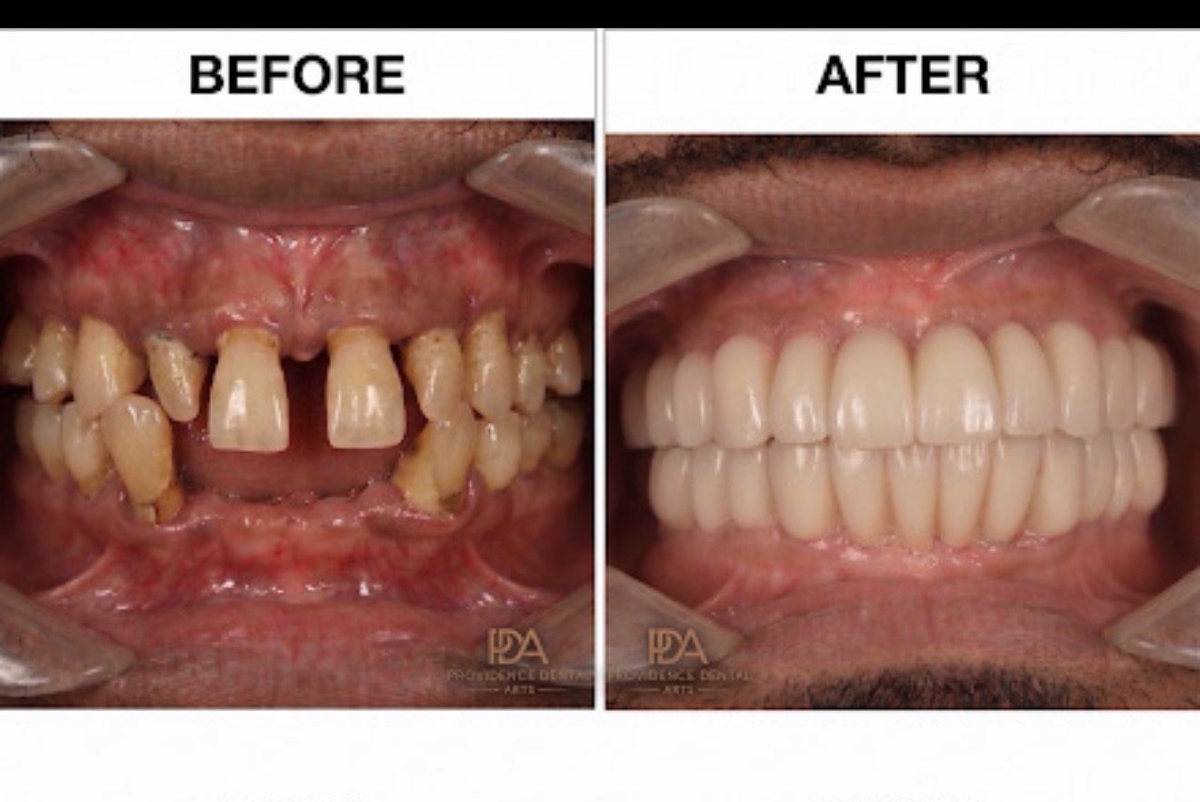 Before and after full-mouth rehabilitation with dental implants at Providence Dental Arts